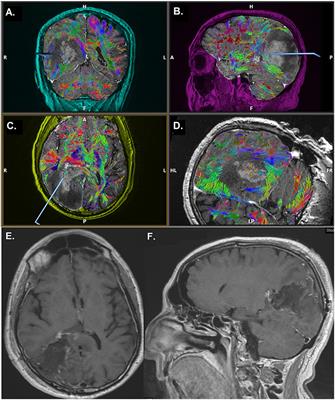 Frontiers | Fluorescence-Guided High-Grade Glioma Surgery More